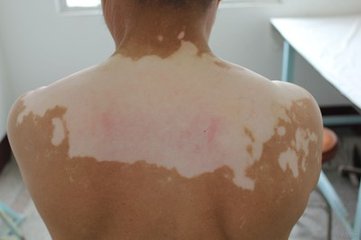 外伤引起的白癜风要注意哪些问题