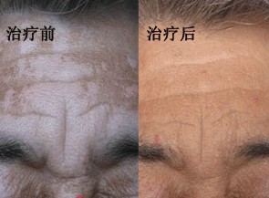 老年人 头部.jpg
